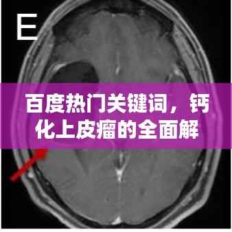 百度热门关键词，钙化上皮瘤的全面解析——从了解、诊断到治疗